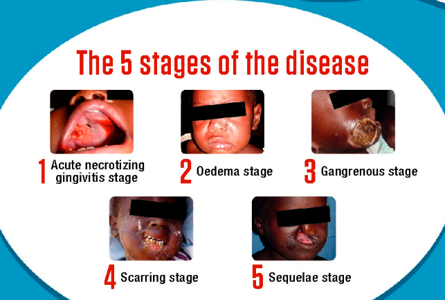 NOMA In Africa Causes Symptoms and Treatment